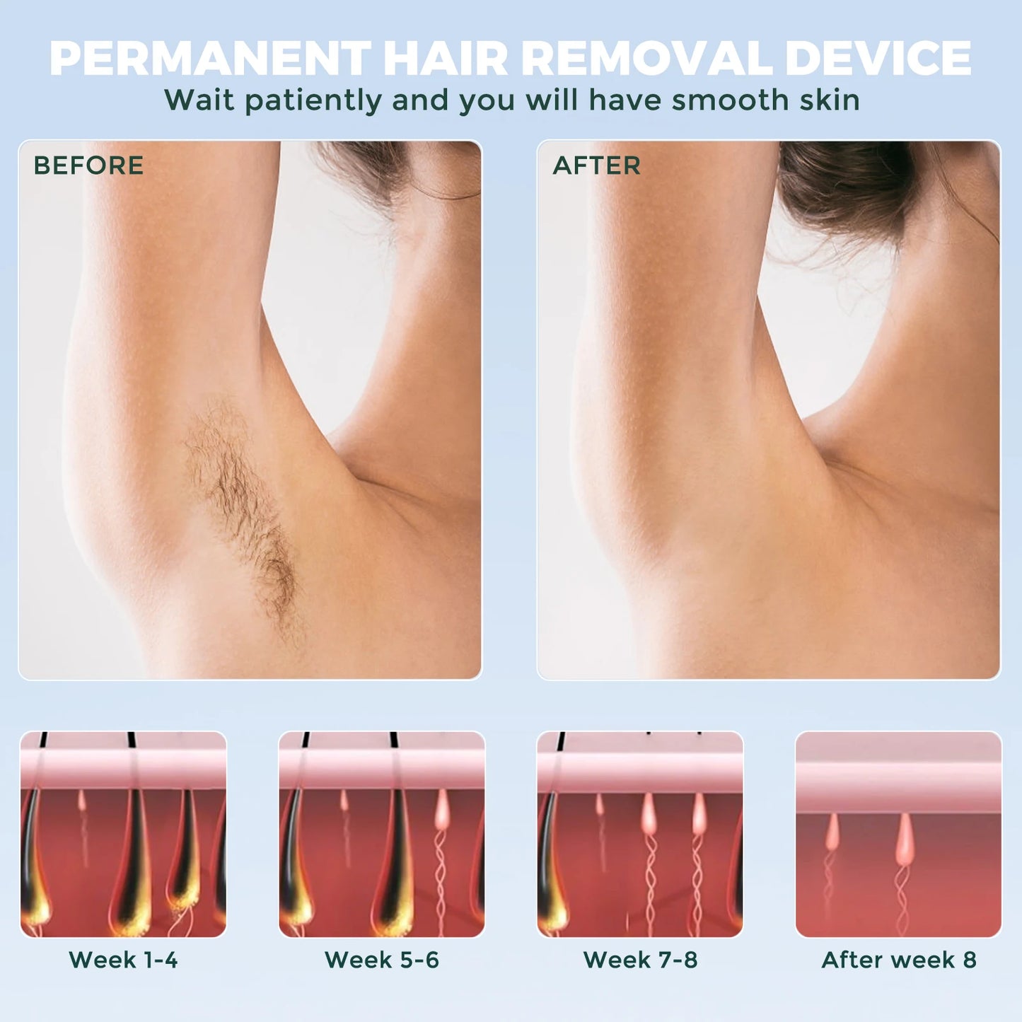 Portable Laser - Painless, Permanent Hair Removal for Women’s Full Body,Bikini,Leg, Face,Underarm